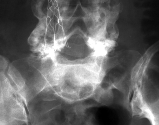 Figure 2: Anteroposterior (AP) radiograph demonstrating pathognomonic inverted Napoleon hat sign.