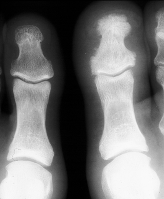 Figure 1: Anteroposterior (AP) radiograph of the great toe demonstrating the classic ivory phalanx sign with diffuse sclerosis of the distal phalanx in psoriatic arthritis.