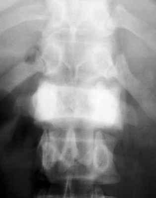 Figure 1: Anteroposterior (AP) radiograph of the lumbar spine demonstrating an ivory vertebra in Paget disease of bone.