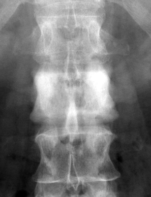 Figure 3: Anteroposterior radiograph demonstrating an ivory vertebra secondary to osteoblastic bone metastasis from breast carcinoma.
