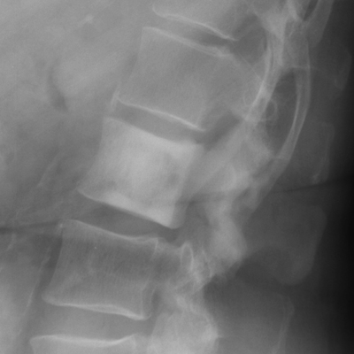 Figure 4: Lateral radiograph illustrating the ivory vertebra sign from osteoblastic breast carcinoma metastasis.