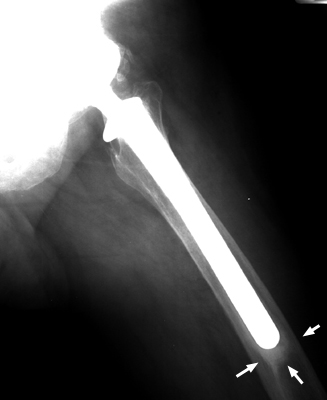 Figure 1: Lateral Radiograph demonstrating pathognomonic features of Pedestal Sign.