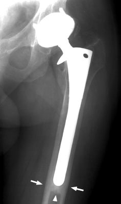 Figure 2: Anteroposterior (AP) Radiograph demonstrating pathognomonic features of Pedestal Sign.