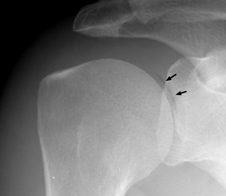 Figure 2: Anteroposterior (AP) shoulder radiograph in external rotation demonstrating the pneumoarthrogram sign.