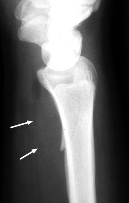 Figure 2: Lateral wrist radiograph demonstrating positive pronator sign.