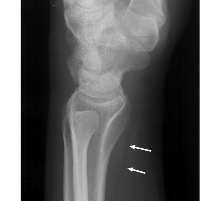 Figure 1: Lateral wrist radiograph demonstrating normal pronator quadratus fat stripe.