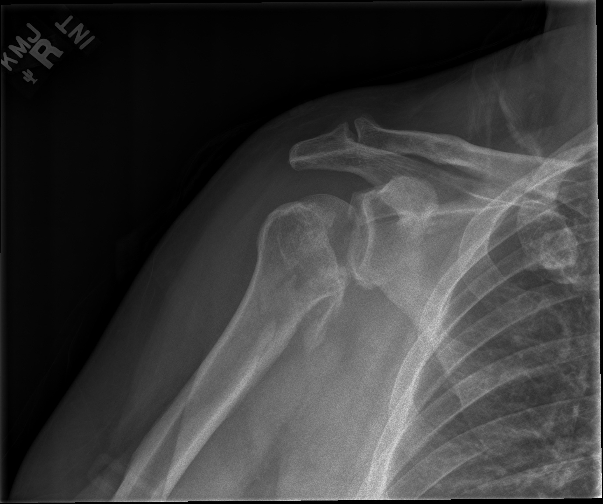Figure 1: Anteroposterior (AP) radiograph demonstrating a Reverse Hill-Sachs lesion and posterior shoulder dislocation.