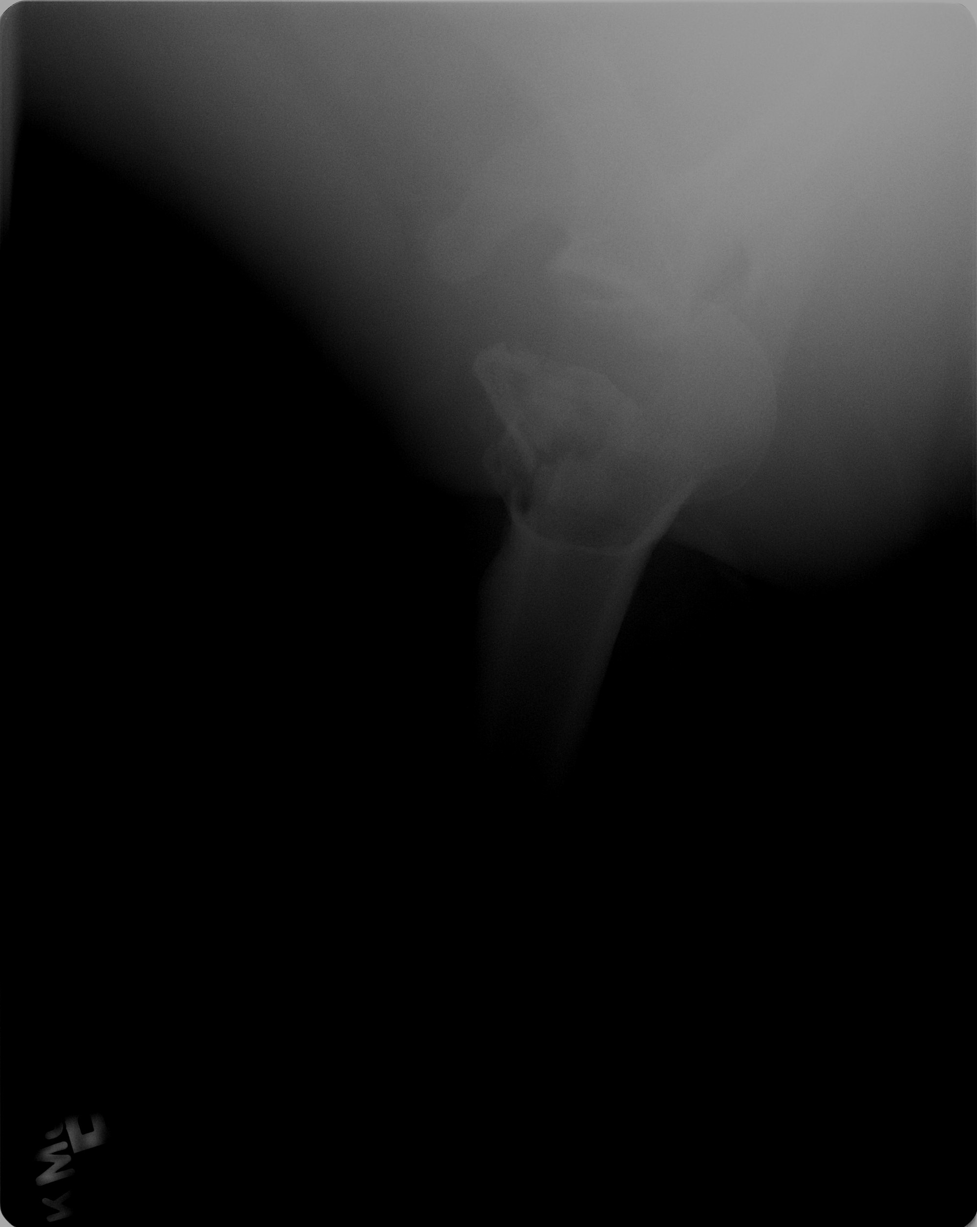Figure 2: Axial radiograph demonstrating posterior glenohumeral dislocation and Reverse Hill-Sachs impaction defect.
