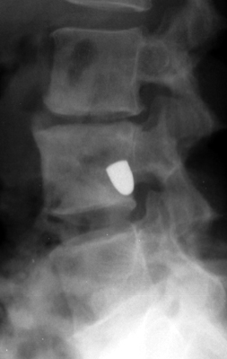 Figure 4: Follow-up lateral plain radiograph of the lumbar spine (Time Point 2) corroborating the altered position and tilt of the tumbling bullet.