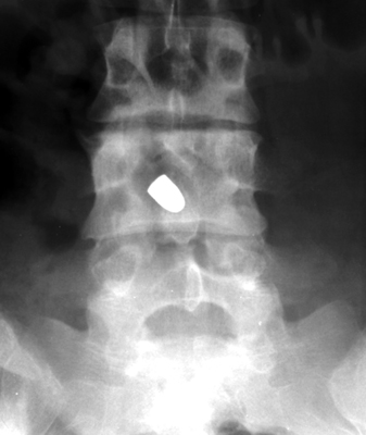 Figure 3: Follow-up anteroposterior (AP) plain radiograph of the lumbar spine (Time Point 2) demonstrating the tumbling bullet sign.