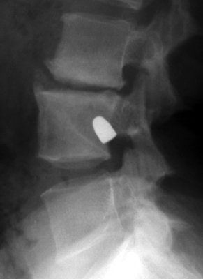Figure 2: Initial lateral plain radiograph of the lumbar spine (Time Point 1) confirming the intraosseous, intracavitary position of the bullet.