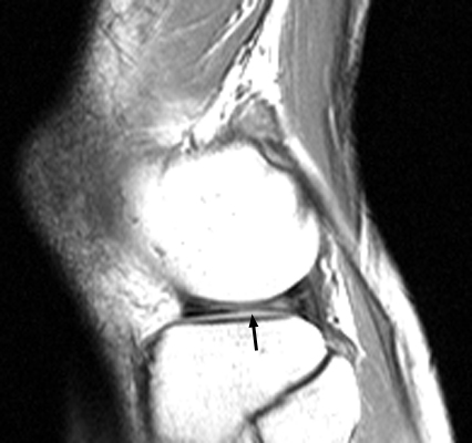 Figure 1: Sagittal knee MRI demonstrating absent bow tie sign with truncated meniscal body.