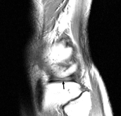 Figure 2: Adjacent sagittal MRI slice confirming truncated meniscal remnant and absent peripheral body continuity.