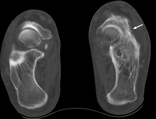 Figure 1: Computed Tomography (CT) reformatted image demonstrating calcaneonavicular coalition with bony bridging and subchondral sclerosis.