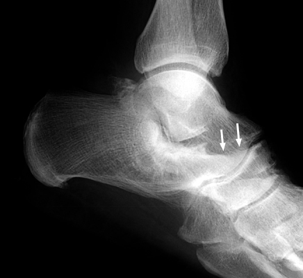 Figure 2: Lateral weight-bearing foot radiograph demonstrating the classic Anteater Nose sign with tubular elongation of the anterior calcaneal process.