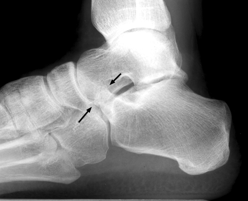 Figure 3: 45-degree medial oblique radiograph demonstrating osseous bridging and articulation narrowing in calcaneonavicular coalition.