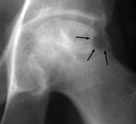 Figure 2: Coned-down AP radiograph of the hip demonstrating catastrophic articular collapse and bite sign.