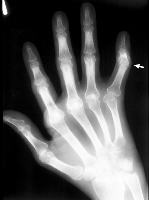 Figure 2: Posteroanterior (PA) plain radiograph of the hand demonstrating multijoint inflammatory arthropathy of rheumatoid arthritis with boutonniere deformities.