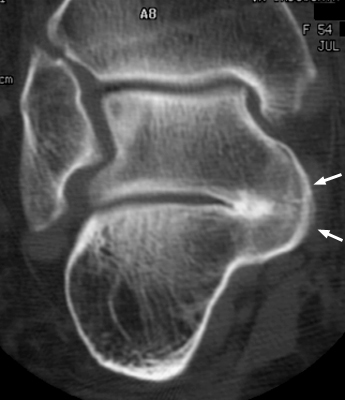Figure 1: Coronal computed tomography (CT) demonstrating definitive osseous bridging across the middle subtalar facet.