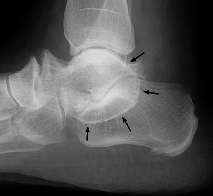 Figure 2: Lateral plain radiograph demonstrating the classic, continuous C-sign of talocalcaneal coalition.