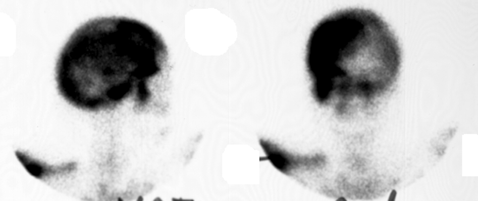 Figure 1: Planar Tc-99m MDP bone scintigraphy showing intense, asymmetric uptake across the cranial vault in Paget's disease.