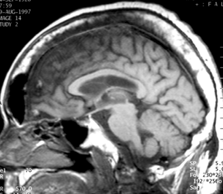 Figure 2: Sagittal T1-weighted MRI showing marked calvarial diploic expansion with preserved heterogeneous fatty marrow signal.