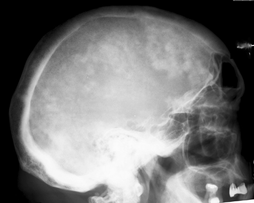 Figure 3: Lateral skull radiograph demonstrating the classic cotton wool sign with thickened calvarium and coalescing fluffy sclerotic foci.
