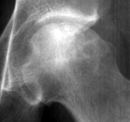 Figure 1: Anteroposterior (AP) Radiograph of Crescent Sign.