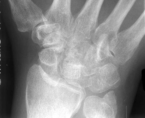 Figure 1: Posteroanterior (PA) plain radiograph of the wrist demonstrating the crowded carpal sign in volar perilunate dislocation.