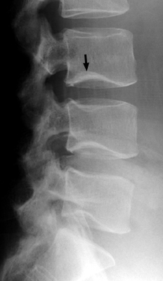 Figure 1: Lateral Radiograph of Cupids Bow Contour.
