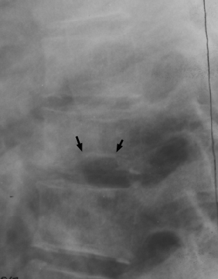 Figure 1: Lateral radiograph of the lumbar spine demonstrating characteristic H-shaped vertebrae with central endplate depression.