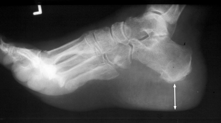 Figure 1: Lateral radiograph of the hindfoot demonstrating increased heel pad thickness (heel pad sign) in a patient with acromegaly.