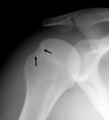 Figure 1: Anteroposterior internal rotation radiograph demonstrating a prominent Hill-Sachs sign.